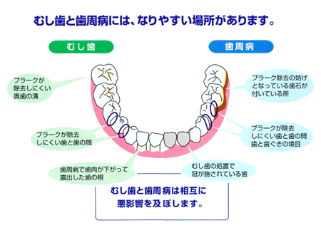 むし歯と歯周病になりやすい場所